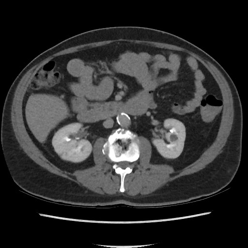 File:Active colonic bleed on CT (Radiopaedia 49765-55025 Axial C+ delayed 36).jpg