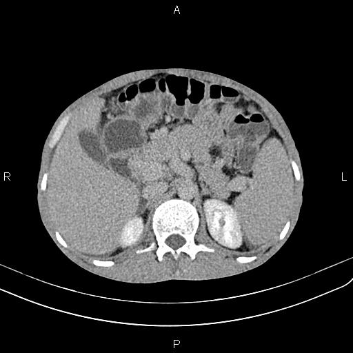 Active crohn disease (Radiopaedia 87133-103397 Axial C+ delayed 8).jpg