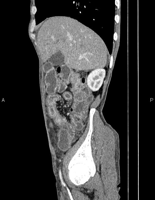 Active crohn disease (Radiopaedia 87133-103397 Sagittal C+ arterial phase 18).jpg