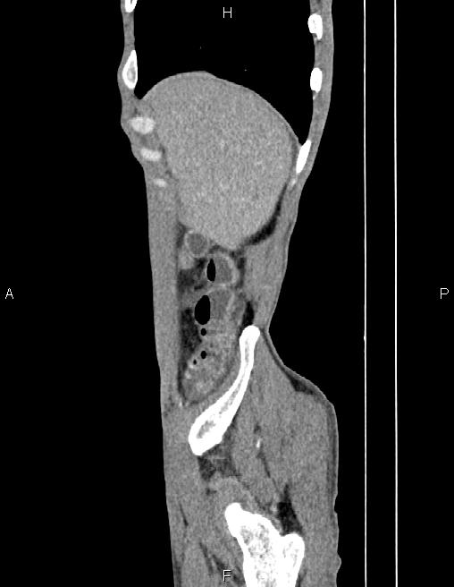 Active crohn disease (Radiopaedia 87133-103397 Sagittal C+ arterial phase 8).jpg