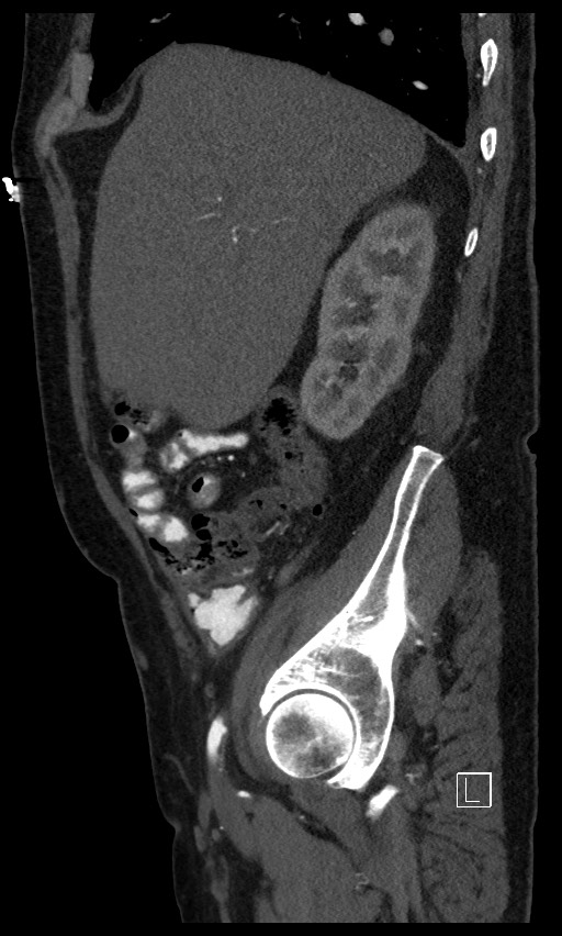 Active lower gastrointestinal bleeding - diverticular (Radiopaedia 61203-69106 Sagittal C+ arterial phase 119).jpg