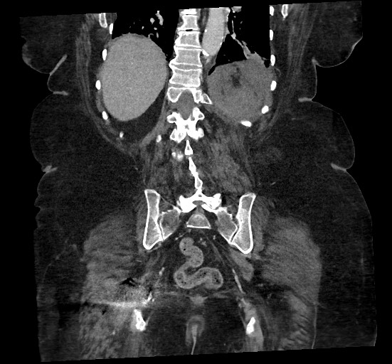 File:Active renal extravasation with large subcapsular and retroperitoneal hemorrhage (Radiopaedia 60975-68796 Coronal C+ portal venous phase 117).jpg