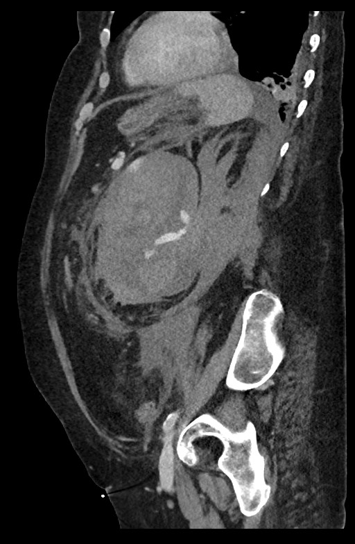 Active renal extravasation with large subcapsular and retroperitoneal hemorrhage (Radiopaedia 60975-68796 Sagittal C+ portal venous phase 80).jpg