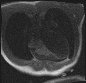 Active right ventricular cardiac sarcoidosis (Radiopaedia 55596-62100 Axial Dynamic perfusion scan MOCO 25).jpg
