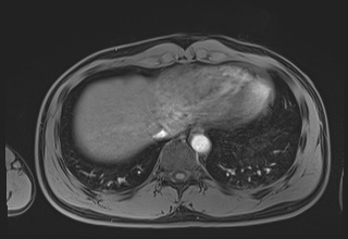 Active right ventricular cardiac sarcoidosis (Radiopaedia 55596-62100 Axial Post contrast Dixon 64).jpg