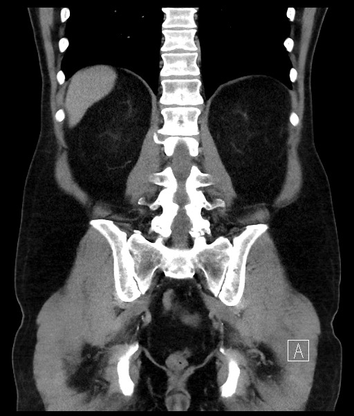 Acute-on-chronic pancreatitis (Radiopaedia 67286-76656 Coronal C+ portal venous phase 56).jpg