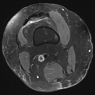 File:Acute-on-chronic transient lateral patellar dislocation with trochlear dysplasia (Radiopaedia 84099-99349 Axial PD fat sat 2).jpg