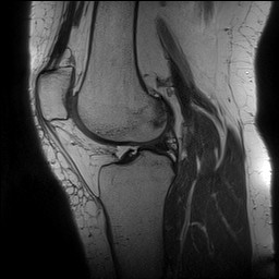 Acute-on-chronic transient lateral patellar dislocation with trochlear dysplasia (Radiopaedia 84099-99349 Sagittal PD 91).jpg