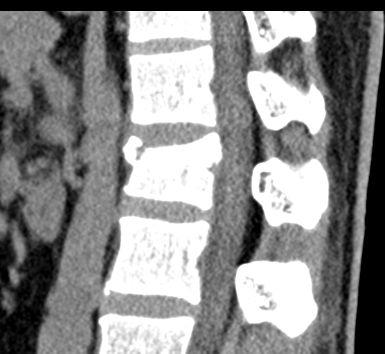 File:Acute L1 burst compression fracture (Radiopaedia 34430-35755 E 50).png