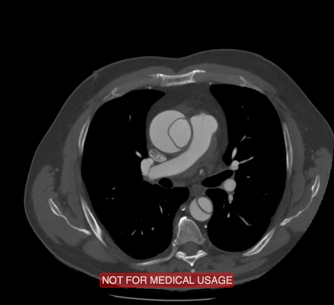 Acute aortic dissection - Stanford type A (Radiopaedia 40661-43285 Axial C+ arterial phase 26).jpg