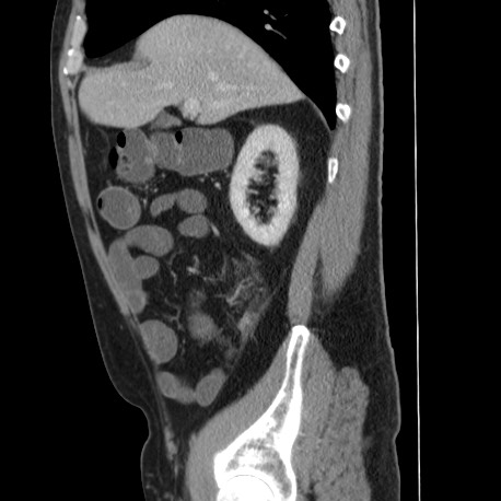 Acute appendicitis (Radiopaedia 66513-75790 Sagittal C+ portal venous phase 45).jpg