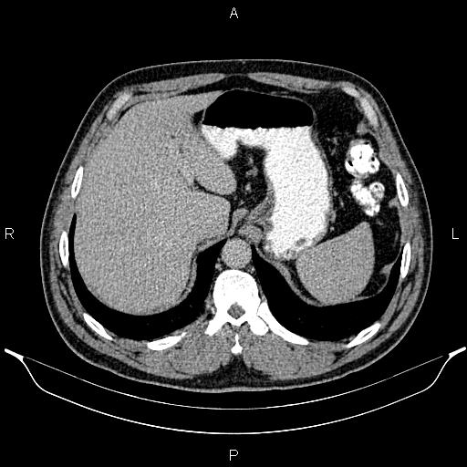 File:Acute appendicitis (Radiopaedia 84780-100240 Axial C+ portal venous phase 21).jpg