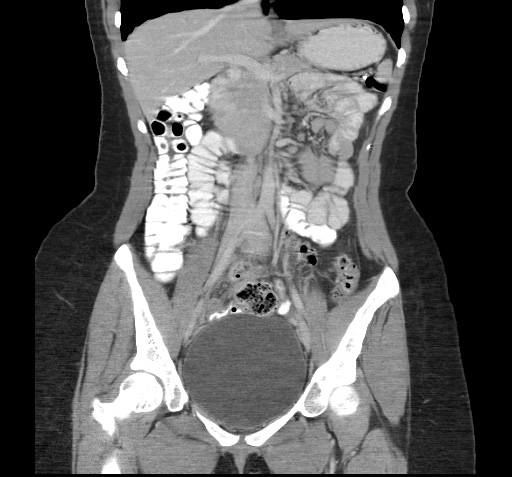 File:Acute appendicitis (Radiopaedia 9417-10099 Coronal C+ portal venous phase 8).jpg