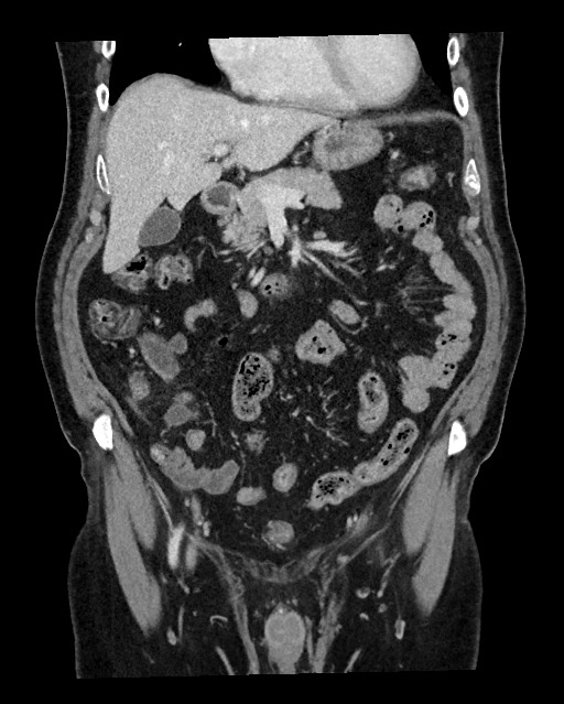 Acute appendicitis - large appendicoliths (Radiopaedia 61805-69820 Coronal C+ portal venous phase 50).jpg