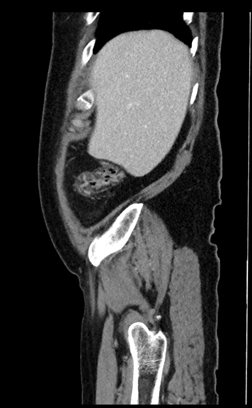 Acute appendicitis - large appendicoliths (Radiopaedia 61805-69820 Sagittal C+ portal venous phase 100).jpg