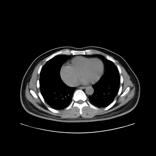 Acute appendicitis and COVID 19 pneumonia (Radiopaedia 76604-88380 Axial non-contrast 36).jpg