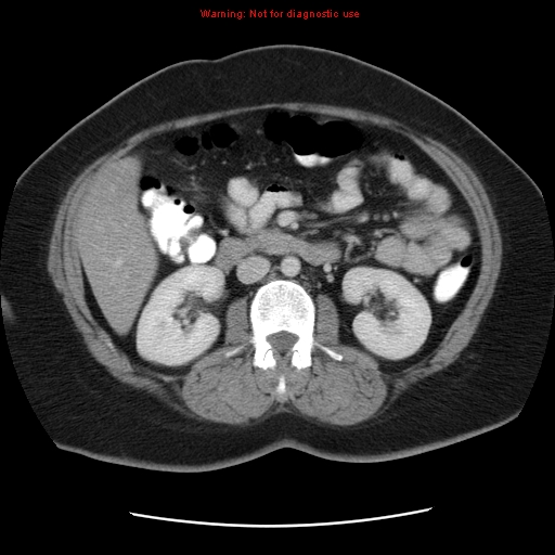 Acute appendicitis complicated by ovarian vein thrombophlebitis (Radiopaedia 16172-15851 Axial C+ portal venous phase 42).jpg