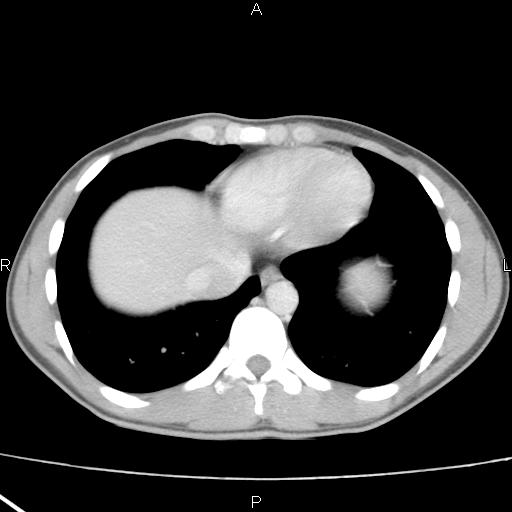 File:Acute appendicitis with CT arrowhead sign (Radiopaedia 21474-21411 Axial C+ portal venous phase 2).jpg