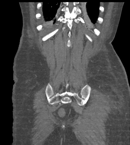 File:Acute bleed from gastric fundus biopsy site (Radiopaedia 35201-36737 Coronal C+ arterial phase 48).png