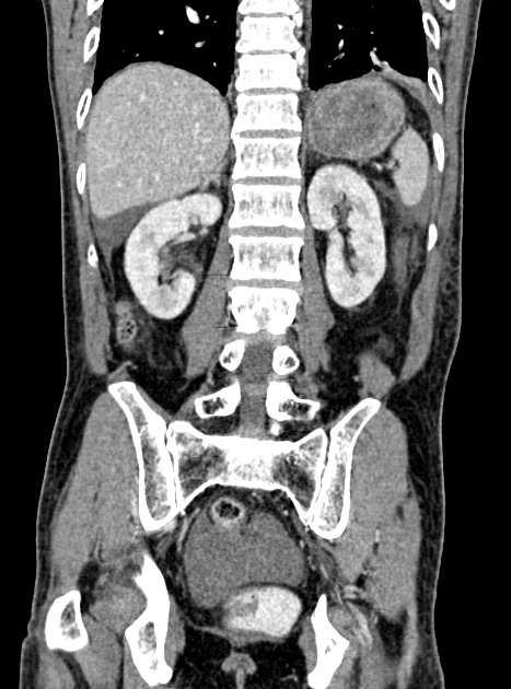 Acute bowel ischemia (Radiopaedia 87695-104114 Coronal C+ portal venous phase 273).jpg