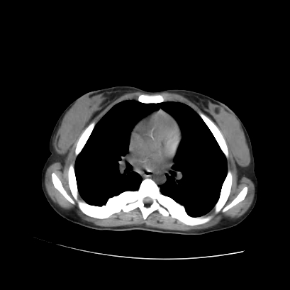 File:Acute calculous cholecystitis in patient with osteopetrosis (Radiopaedia 77871-90159 Axial non-contrast 3).jpg
