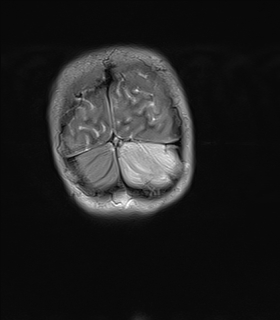 File:Acute cerebellar ataxia (Radiopaedia 61487-69446 Coronal T2 16).jpg