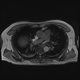 Acute cholecystitis (Radiopaedia 72392-82923 Axial T1 out-of-phase 4).jpg