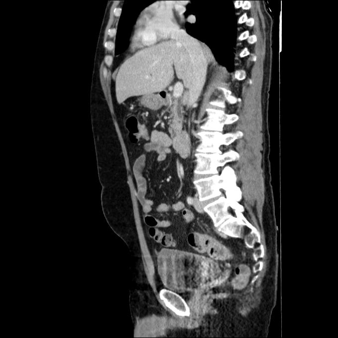 Acute cholecystitis and incidental left sided IVC (Radiopaedia 49352-54459 Sagittal C+ portal venous phase 52).jpg