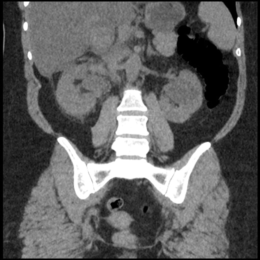 File:Acute cholecystitis and ureteric colic (Radiopaedia 42330-45444 Coronal prone 65).jpg