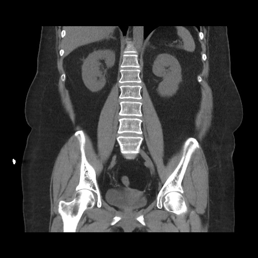 Acute cholecystitis with tensile fundus sign (Radiopaedia 71394-81723 Coronal non-contrast 79).jpg