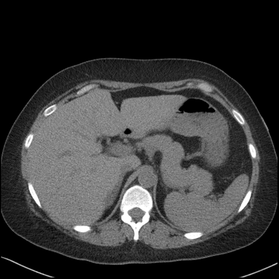 Acute colonic hemorrhage in ulcerative colitis (Radiopaedia 77415-89538 Axial non-contrast 32).jpg