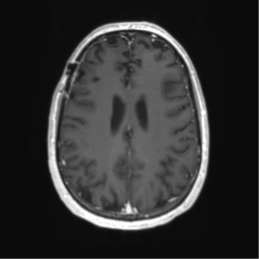 Acute disseminated encephalomyelitis (ADEM) (Radiopaedia 65319-74350 Axial T1 C+ 43).png