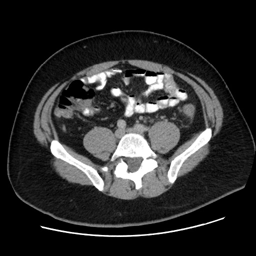 Acute diverticulitis with localized perforation (Radiopaedia 41296-44113 Axial C+ portal venous phase 61).jpg