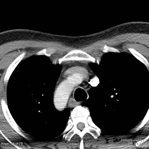 Acute epiglottitis (Radiopaedia 54375-60590 Axial C+ arterial phase 74).jpg