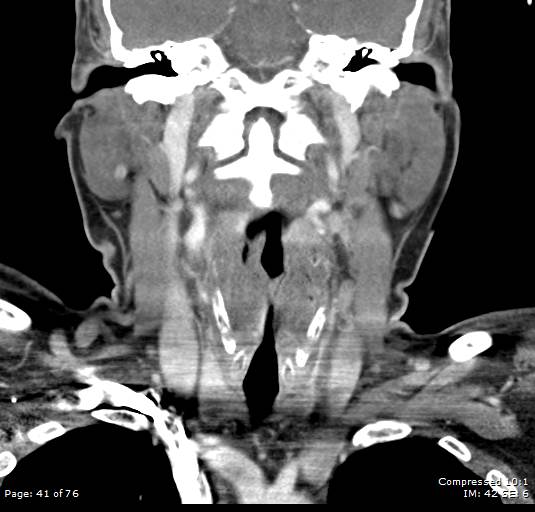 Acute epiglottitis (Radiopaedia 54375-60590 Coronal C+ arterial phase 41).jpg