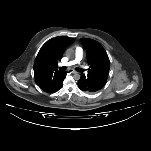 File:Acute heart failure (CT) (Radiopaedia 79835-93075 Axial C+ arterial phase 8).jpg