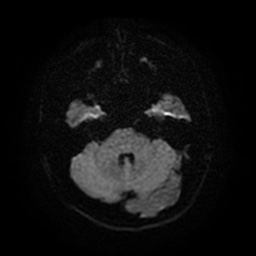 Acute internal carotid artery dissection (Radiopaedia 53541-59632 Axial DWI 8).jpg