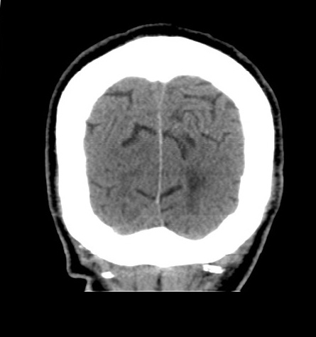 Acute left anterior cerebral artery territory infarction (Radiopaedia 51785-57578 Coronal non-contrast 53).jpg