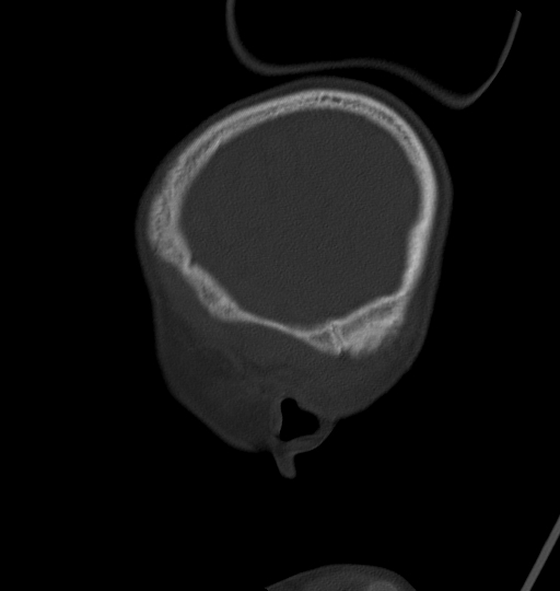 Acute mastoiditis (Radiopaedia 82678-96881 Sagittal bone window 61).jpg