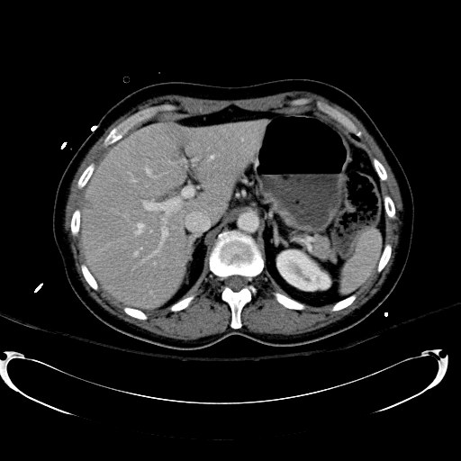 File:Acute myocardial infarction in CT (Radiopaedia 39947-42415 Axial C+ portal venous phase 33).jpg