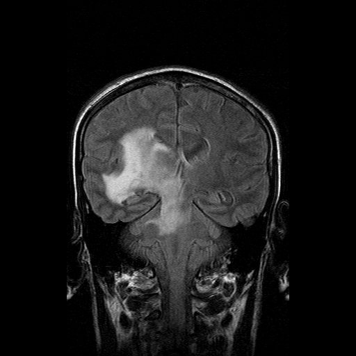 File:Acute necrotizing toxoplasma encephalitis (Radiopaedia 10683-11149 Coronal FLAIR 8).jpg