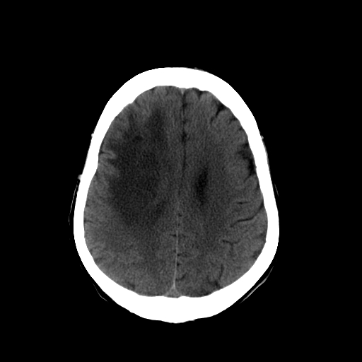 File:Acute necrotizing toxoplasma encephalitis (Radiopaedia 10683-11150 B 11).jpg