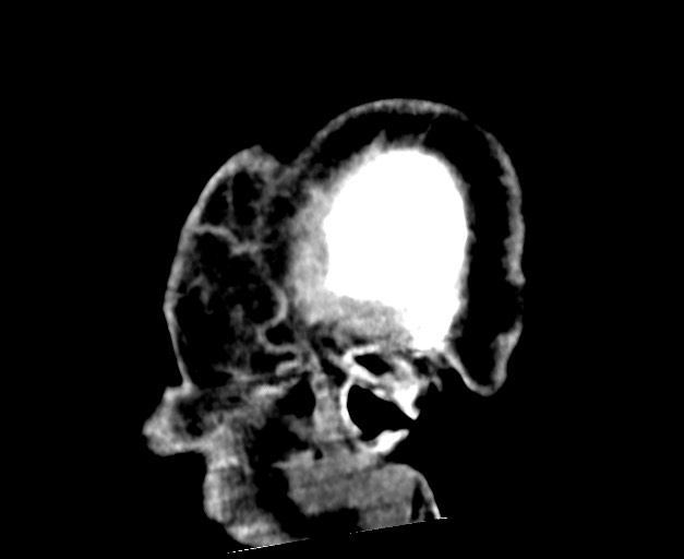 Acute on chronic subdural hematoma (Radiopaedia 78346-90966 Sagittal non-contrast 52).jpg
