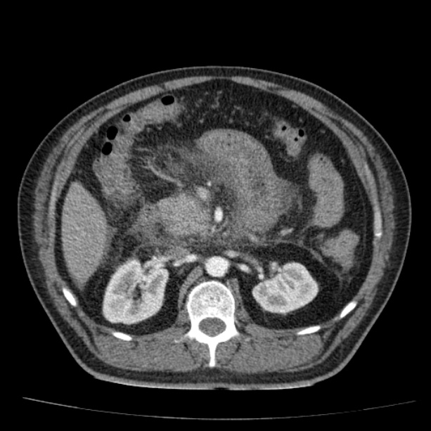 Acute pancreatitis (Radiopaedia 26663-26813 Axial C+ arterial phase 41).jpg