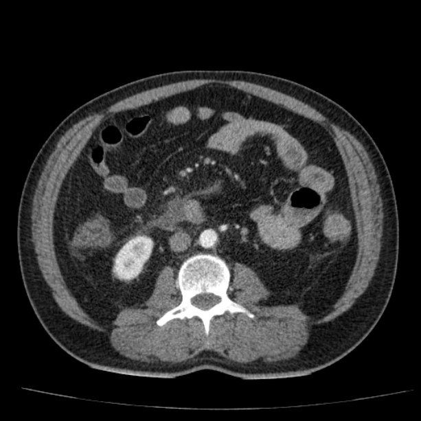 Acute pancreatitis (Radiopaedia 26663-26813 Axial C+ arterial phase 55).jpg