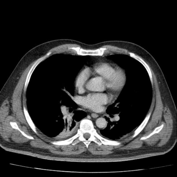 Acute pancreatitis (Radiopaedia 26663-26813 Axial C+ portal venous phase 1).jpg