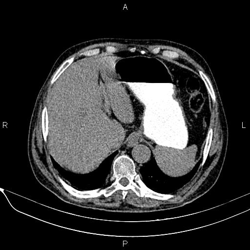 Acute pancreatitis (Radiopaedia 85146-100701 Axial non-contrast 25).jpg