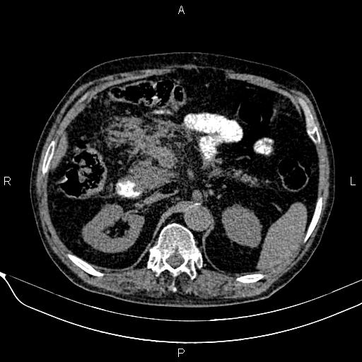 Acute pancreatitis (Radiopaedia 85146-100701 Axial non-contrast 45).jpg