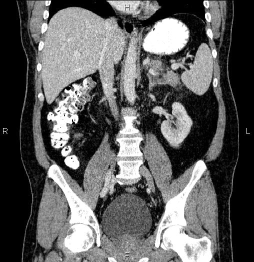Acute pancreatitis (Radiopaedia 85390-101010 Coronal C+ portal venous phase 41).jpg