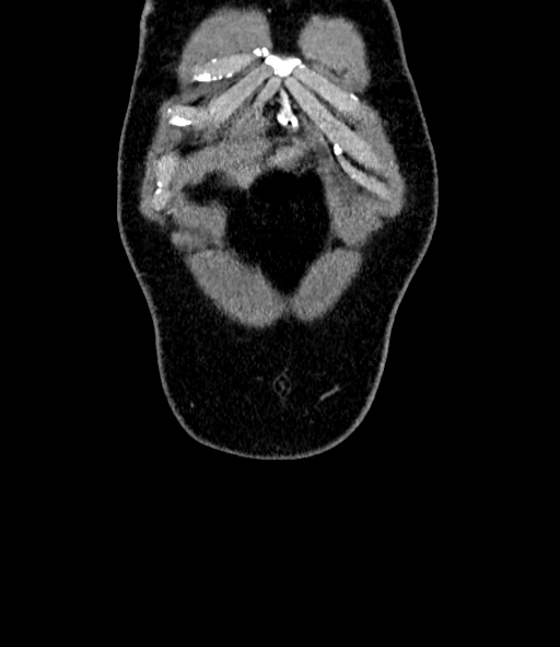 File:Acute pancreatitis (Radiopaedia 87428-103757 Coronal C+ portal venous phase 5).jpg